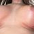 Mastopexia con implantes