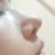 Bulto en cartilago del dorso de la nariz