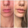 Aumento de labios con ácido hialurónico - 50095