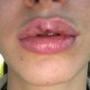 Aumento de labios con ácido hialurónico - 50097