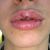 Aumento de labios con ácido hialurónico (Hydryalix Volume)