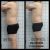 Abdominoplastia en Sant Joan Despi