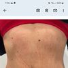 Liposucion abdomen bajo