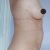 Lipoláser abdominal Dr. Andrés Román y Dra. Xana Palomo
