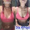 Mastopexia periareolar