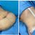 Abdominoplastia