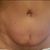 Retoque de una abdominoplastia