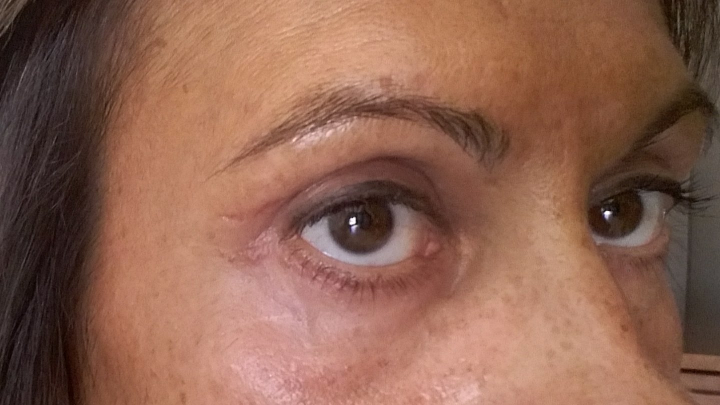 hematoma en el rabillo del ojo hematoma en el rabillo del ojo