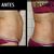 Reafirmación de abdomen con Capenergy