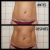 Reafirmación de abdomen con Capenergy