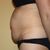 Mi experiencia de abdominoplastia en Sevilla