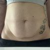 Abdominoplastia con diastasis