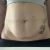 Abdominoplastia con diastasis