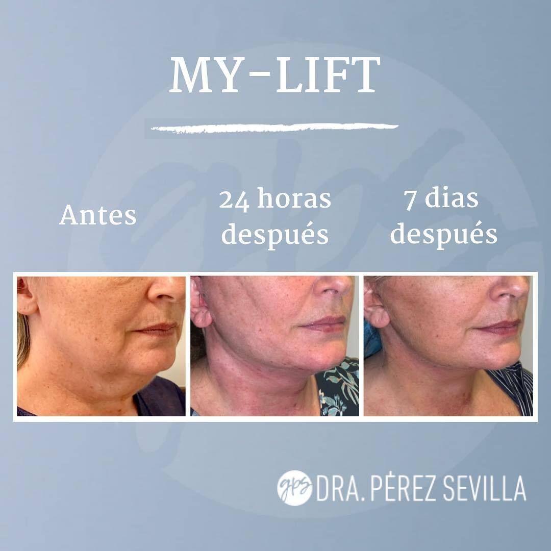 Lifting de cuello espectacular Lifting