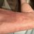Decepcionante liposucción +bodytite