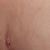 Tuve complicaciones tras la liposucción