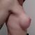Aumento de pecho, 360cc redondas submuscular