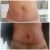 Abdominoplastia de 10!!