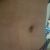 Abdominoplastia de 10!!
