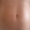 Tratamiento carboxiterapia