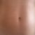Tratamiento carboxiterapia