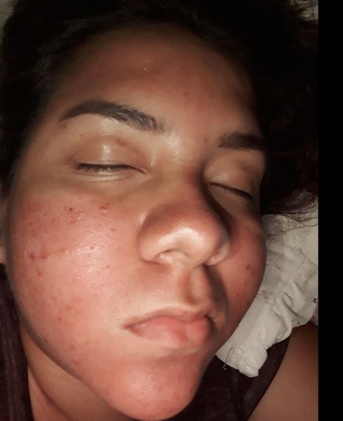 cuanto duran los moretones en la cara