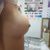 Mastopexia con protesis 320cc