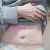 Mi experiencia,abdominoplastia con plicatura de rectos