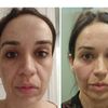 Rejuvenecimiento facial con Dra. Beatriz Moralejo - 28325