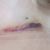 Hematomas aumento pecho