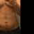 Lipo Vaser pero aun recuperandome