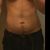 Lipo Vaser pero aun recuperandome