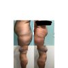 Liposucción con bodytite