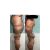 Liposucción con bodytite