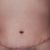Por fin me hicieron mi abdominoplastia