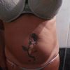  lipoabdominoplastia