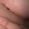 Herida abierta tras un mes de aumento de pecho