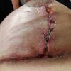 Cremas o aceites para cicatrices en los pechos después de un levantamiento de mamas?