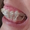 Dudas sobre tratamiento ortodoncia