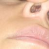 Rinoplastia secundaria bulto en interior de la nariz dificultad para respirar