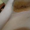 Recién Operada de pecho 