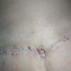 Abdominoplastia posterior de flancos con grasa trasladada a gluteo