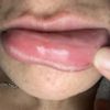 Ácido hialuronico en los labios