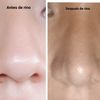 Rinoplastia marcas en punta de nariz postoperatorio 