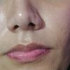 Rinoplastia marcas en punta de nariz postoperatorio 