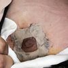 Pezones normales? Infección? Mala cicatrización?