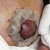 Pezones normales? Infección? Mala cicatrización?