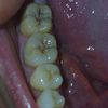 Muelas con caries o manchas