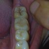 Muelas con caries o manchas