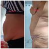 10 días de mi cirugía de Abdominoplastia